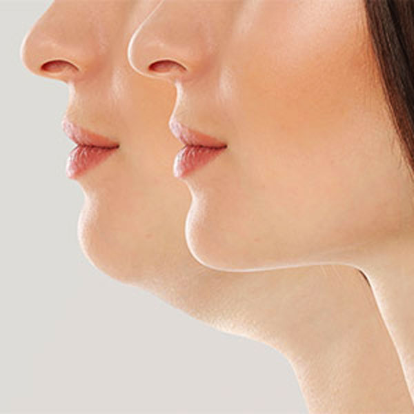 مزوژل غبغب|