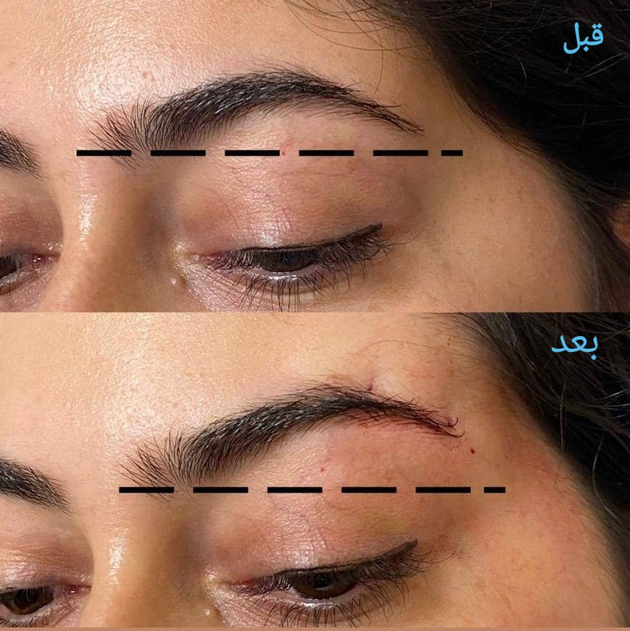 ماندگاری نخ لیفت ابرو چقدر است؟ ⏳
