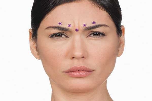 خط اخم چیست و چگونه ایجاد می‌شود 💉