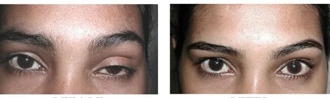 بوتاکس چشم گربه ای