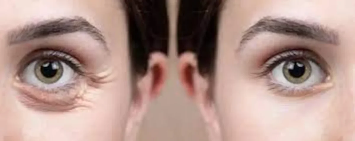 مزوتراپی زیرچشم