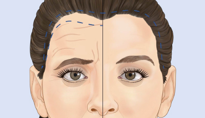 بوتاکس ابرو چیست و چگونه عمل می‌کند؟ 💉