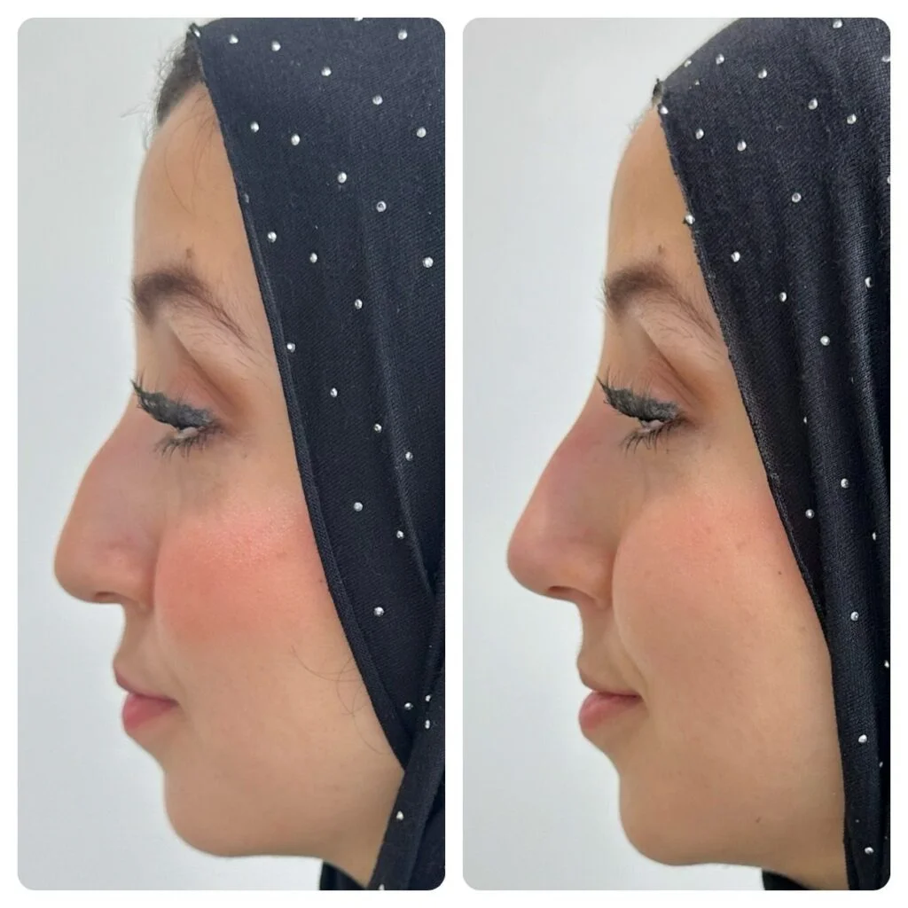 نخ لیفت بینی