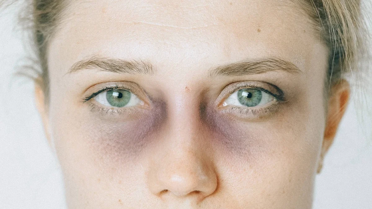 ورم و کبودی بعد از تزریق فیلر زیر چشم 👁💉