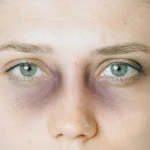 ورم و کبودی بعد از تزریق فیلر زیر چشم 👁💉