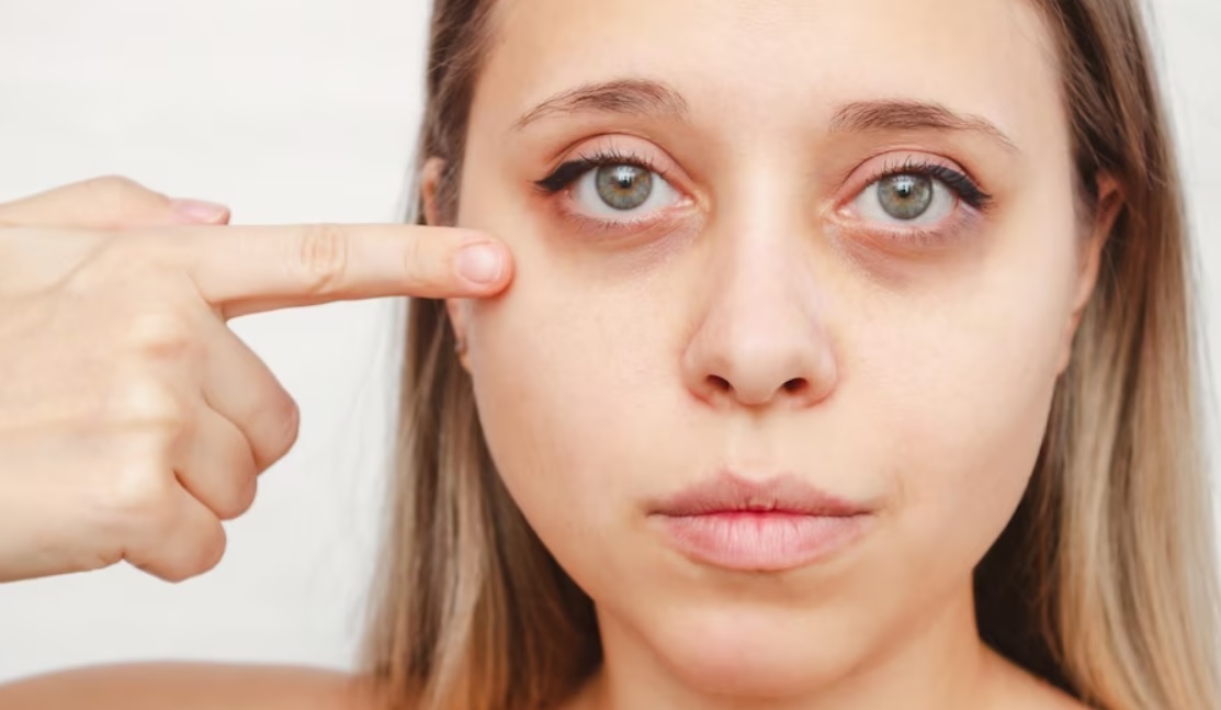 عوارض و خطرات فیلر زیر چشم 👁⚠️