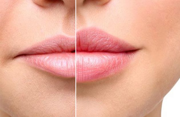 روش‌های مختلف حجم‌دهی به لب‌ها 💉