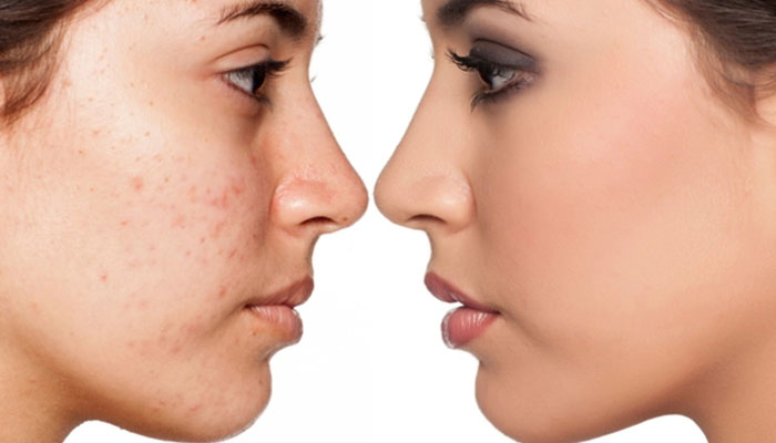 مزوژل جای جوش