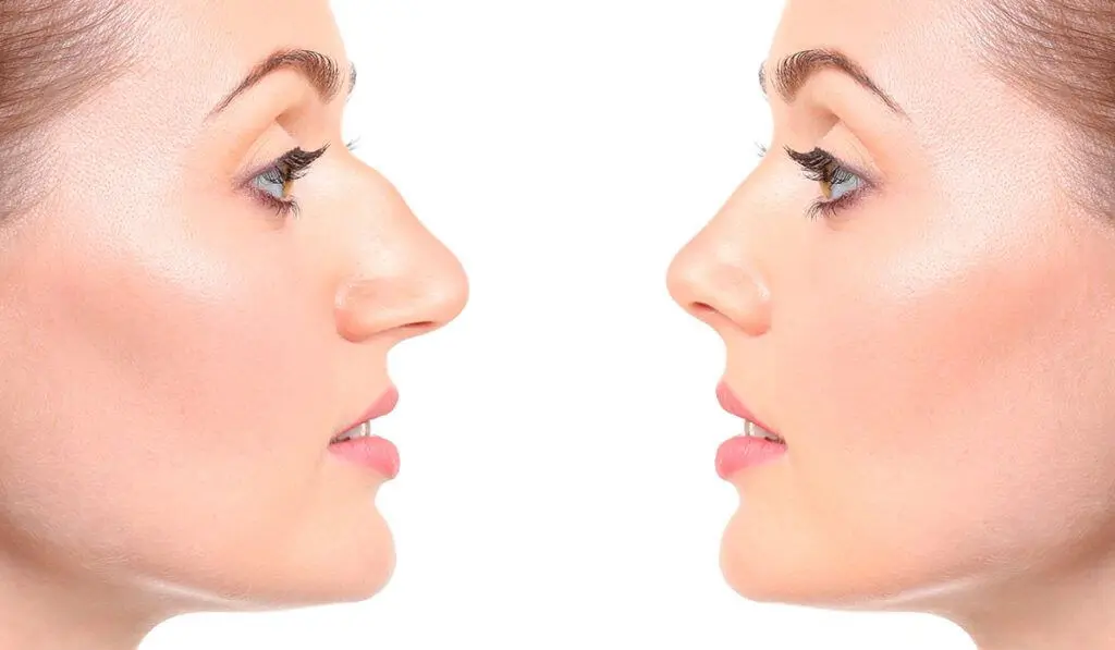 نحوه عملکرد نخ لیفت بینی 🪡