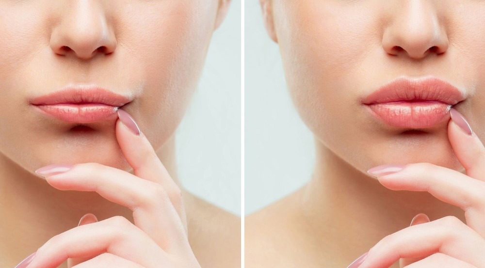 نکات مهم برای افزایش ماندگاری فیلر لب 💋