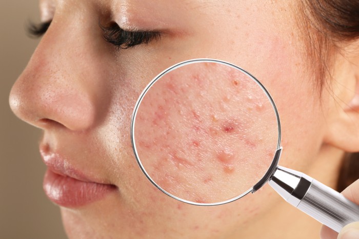 مزوژل جای جوش