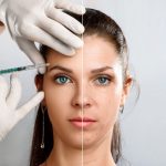 نقاط تزریق بوتاکس چشم گربه‌ای 😻💉