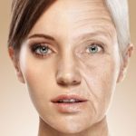 بوتاکس برای رفع چین و چروک