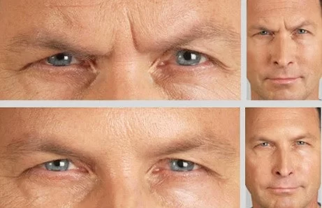 نحوه عملکرد بوتاکس در کاهش خطوط اخم ⚡