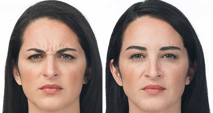 بوتاکس پیشانی بهتر است یا خط اخم جداگانه؟