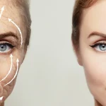 لیفت شقیقه یا بوتاکس: کدام روش مناسب‌تر است؟