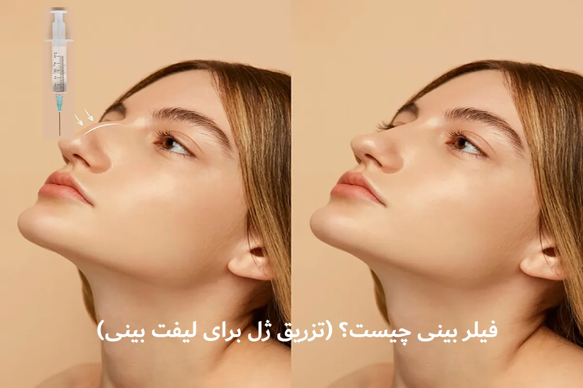 فیلر بینی چیست و چگونه عمل می‌کند؟ 💉
