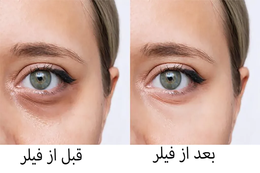نقش سبک زندگی در مدت ماندگاری فیلر زیر چشم 🍏