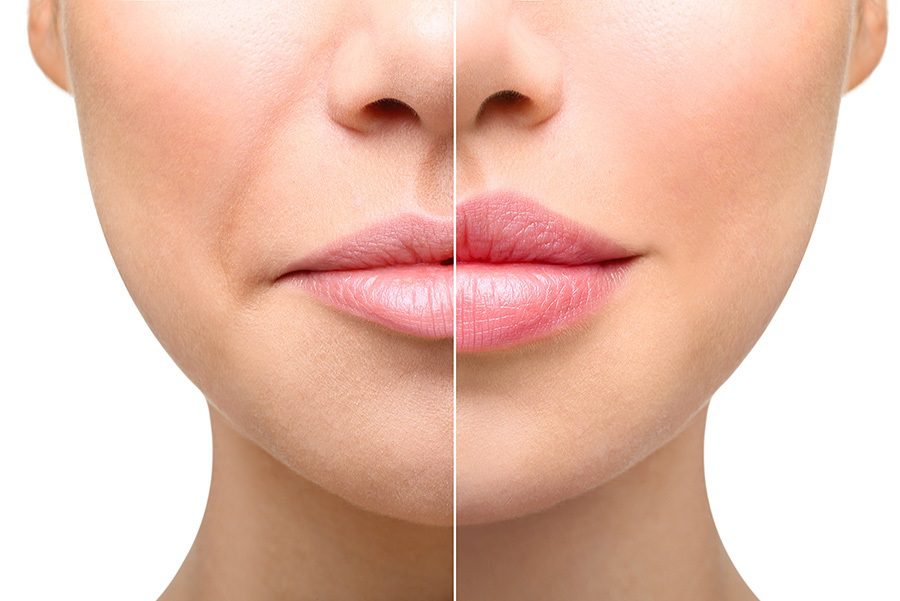 تأثیر تکنیک تزریق و مهارت پزشک بر ماندگاری فیلر خط خنده 🌿