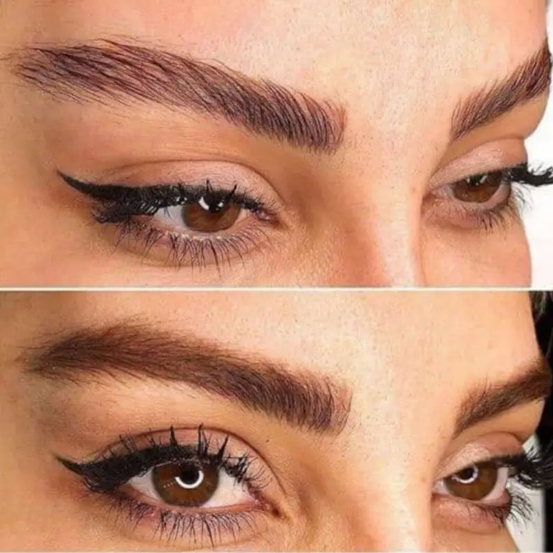 بوتاکس چشم گربه‌ای