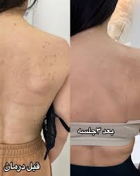میکرونیدلینگ پشت بدن