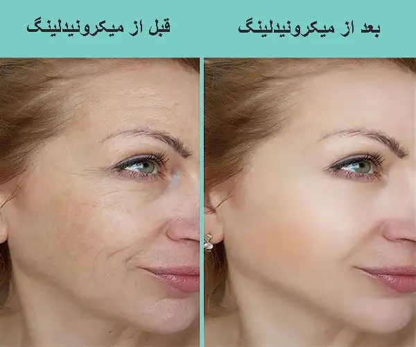 میکرونیدلینگ چانه
